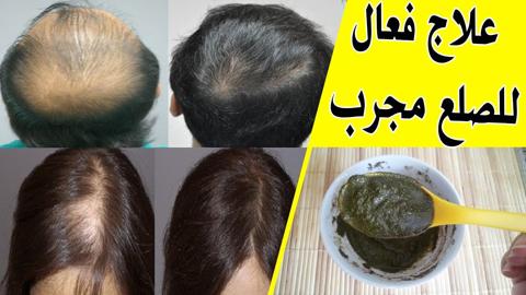 وصفة سحرية وفعالة لعلاج تساقط الشعر والثعلبة